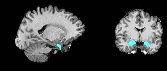 Scans of the human brain highlighting the amygdala